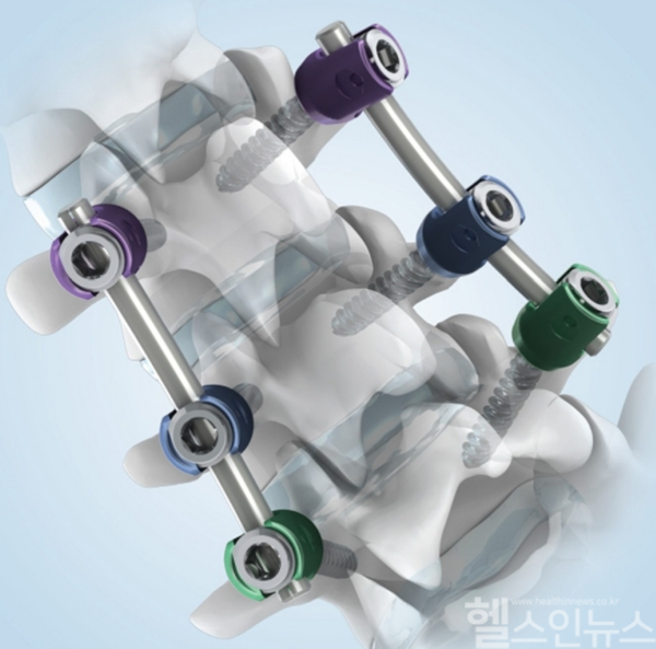 시지메드텍의 대표 제품 ANAX 5.5는 척추 후방 고정장치로, 우수한 고정력과 설계 완성도를 갖춰 글로벌 시장에서 신뢰를 받고 있다. (시지메드텍 제공)