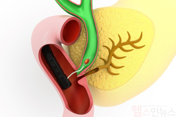 ERCP를 통한 담관결석 제거 일러스트 (한림대학교동탄성심병원 제공)