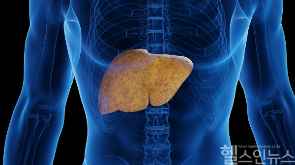 국내 연구팀이 대사이상 지방간 환자의 간이 굳어가는 정도를 정확히 알 수 있는 새로운 기준을 발견했다. (클립아트코리아)