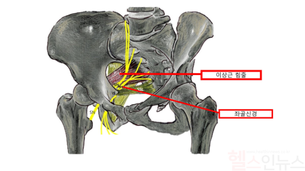 이상근 힘줄 설명 그림 (서울성모병원 제공)
