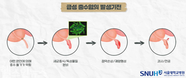 급성 충수염 발생기전 (서울대학교병원 제공)