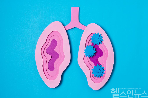 폐암 초기로 진단된 경우 보통 외과적 절제술이 시행됐지만 최근에는 방사선을 이용한 수술적 치료가 각광받고 있다. 두 가지 치료법 모두 장단점이 존재하므로 환자 개인별 맞춤형 접근이 중요하다. (클립아트코리아)