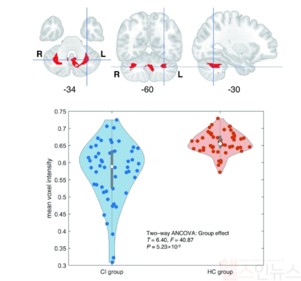 나이와 성별이 같은 정상 청력군과 난청 환자군의 소뇌 위축 정도 비교. 상단의 뇌 그림에서 빨간색 부위는 난청 환자군에서 유의하게 위축이 발생한 소뇌 회백질 영역을 나타낸다. 하단의 그림은 난청 환자(좌하단, 파란색)와 정상 청력군(우하단, 빨간색) 개개인의 ‘소뇌 회백질 영역’내 평균 회백질 두께를 시각화한 바이올린 그래프이다. 난청 환자의 평균 회백질 두께가 정상 청력군에 비해 유의하게 작음(아래로 더 길쭉한 바이올린 형태)을 알 수 있다. (강남세브란스병원 제공)