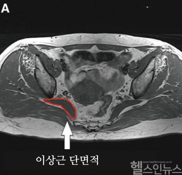 이상근 단면적 MRI 사진 (국제성모병원 제공)