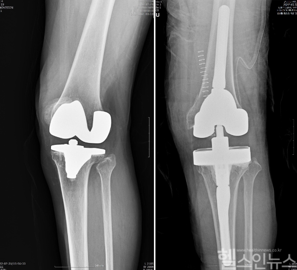 인공관절 재치환술 전후 (연세사랑병원 제공)