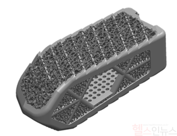 시지메드텍, ‘환자맞춤형 추간체 유합(PSIF, Patient Specific Interbody Fusion)’ 케이지 국내 허가 획득 (시지메드텍 제공)