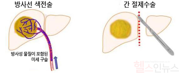 크기가 큰 간암에서 방사선색전술과 간절제 수술. 크기가 큰 간암은 수술이 어려운 경우가 많은데, 방사선색전술을 통해 수술과 유사한 생존율로 치료가 가능하다는 사실이 서울대병원 연구팀에 의해 확인됐다. (서울대병원 제공)