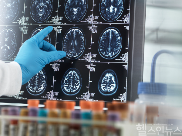 이민우 한림대성심병원 교수와 안은희 교수 연구팀이 혈관성 인지저하 환자에서 Netrin-1의 신경보호 기전과 바이오마커 역할을 규명하는 연구로 기초연구사업에 선정돼, 3년간 6억5000만원의 연구비를 지원받는다. (클립아트코리아)