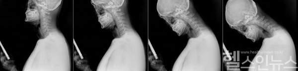 스마트폰 이용 시 목의 변화 X-ray (바른세상병원 제공)