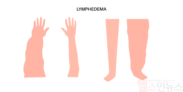암 치료 후 발생하는 림프부종은 조기 진단과 꾸준한 관리로 증상 완화가 가능하며, 방치 시 피부 변형과 감염 위험이 커진다. (클립아트코리아)