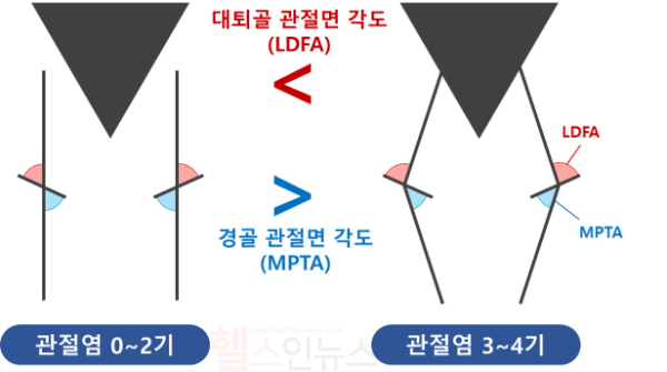 관절염 심각도별 선천적인 무릎 변수 차이. 관절염 3~4기 환자는 0~2기 대비 대퇴골 관절면 각도(LDFA)가 크고 경골 관절면 각도(MPTA)가 작아, 내반 정렬의 특성이 뚜렷했다. (서울대병원 제공)