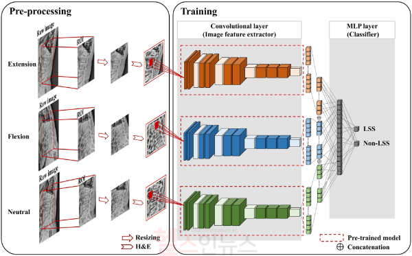 다중 자세 X선 사진을 기반으로 AI 모델이 요추협착증(LSS)을 분류하는 작업 흐름: 세 가지 자세에서 추출된 특징을 결합해 요추협착증을 진단함. (서울대병원 제공)