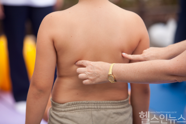 피부가 검게 변하는 ‘흑색가시세포증’은 청소년 비만과 대사 질환의 경고 신호로, 조기 진단과 체중 관리가 중요하다. (클립아트코리아)