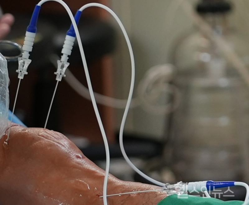 수술 후 통증 완화를 돕는 고주파 열 치료술/사진=연세사랑병원 제공