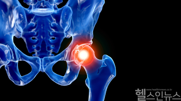 사타구니 통증이 2주 이상 지속된다면, 퇴행성 고관절염을 의심하고 정확한 감별 진단이 필요하다. (클립아트코리아)
