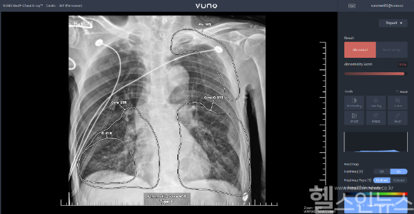 뷰노 AI 기반 흉부 X-ray 판독 및 소견 검출 의료기기 VUNO Med®-Chest X-ray™ (뷰노 제공)