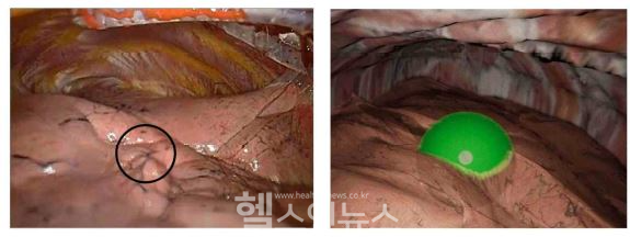 (왼쪽부터) 폐결절 위치를 나타낸 실제 흉강경 영상 및 시뮬레이션 영상 캡처 (고대안산병원 제공)