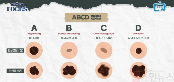 ABCD 자가진단 체크포인트 (서울대병원 제공)