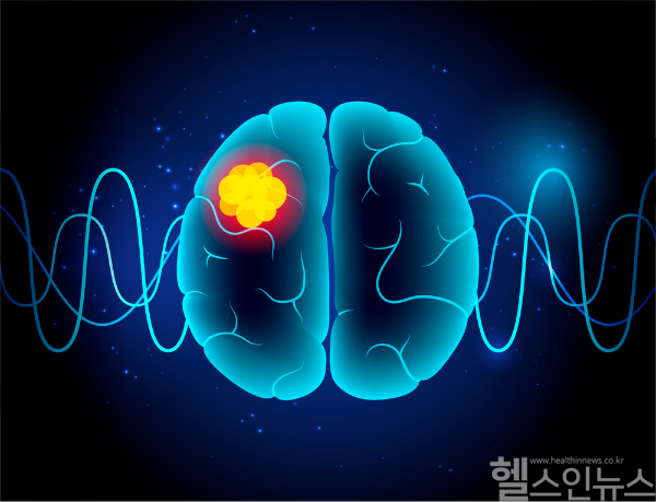 교모세포종은 빠르게 진행하는 악성 뇌종양으로, 두통과 경련 등 증상 발생 시 즉시 의료진 진료가 필요하다. (클립아트코리아)