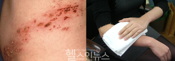 "여름철 급증하는 대상포진, 빠른 치료가 핵심" (미래본병원 제공)