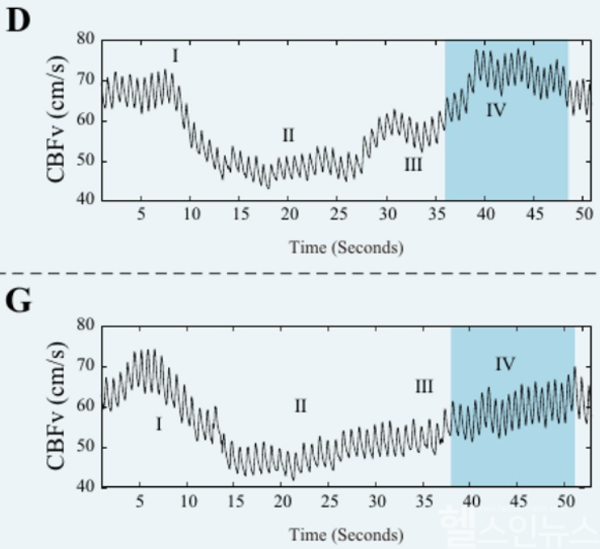 과관류증후군 발생 환자(G)와 그렇지 않은 환자(D)의 뇌혈류 속도 비교. 발살바호흡을 통해 동맥혈압이 낮아졌다가 정상으로 되돌아갈 때(Ⅳ구간), 과관류증후군 발생 환자는 그렇지 않은 환자보다 뇌혈류 속도가 서서히 증가하고, 뇌혈관 반응성이 떨어지는 것으로 나타났다. (서울대병원 제공)