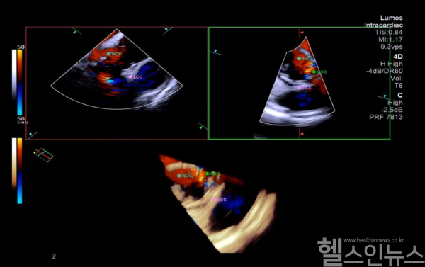 4차원(4D) 심장내 초음파(intracardiac echocardiography, ICE) 영상 이미지 (중앙대광명병원 제공)