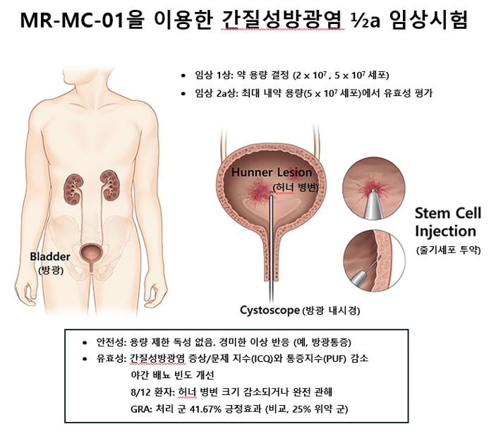 난치성 질환 간질성방광염 줄기세포치료제로 세계 첫 임상시험 성공