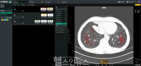 AVIEW LCS Plus Summary page (코어라인소프트 제공)