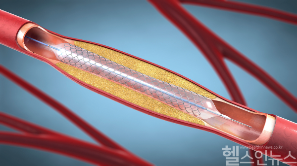 스텐트 시술과 수술은 각기 장단점이 있어, 개인 상태에 맞는 맞춤 치료가 중요하다. (클립아트코리아)