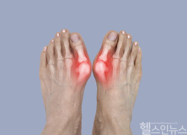 무지외반증은 조기 치료가 중요하며, 심하면 흉터 없이 빠른 회복 가능한 최소침습 수술이 효과적이다. (클립아트코리아)