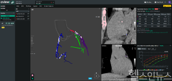 코어라인소프트 AVIEW CAC (코어라인소프트 제공)