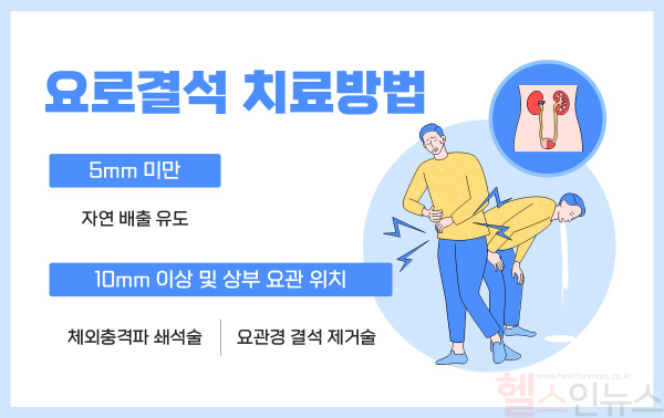 요로결석 치료방법 (힘찬병원 제공)