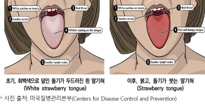 청주시 "갑자기 열나고 딸기혀 보이면 '성홍열' 의심하세요" (청주시 제공)