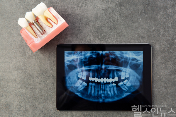 임플란트 회복과 장기 유지를 위해 철저한 구강 관리와 정기 검진이 필수다. (클립아트코리아)