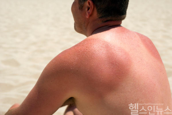 폭염 속 자외선 차단과 계획적인 태닝으로 일광화상을 예방하세요. (클립아트코리아)