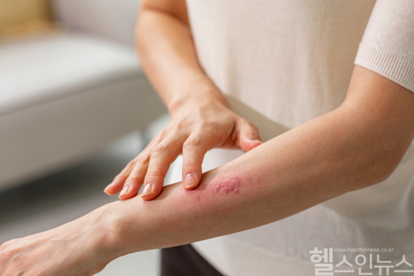 여름철 급격한 온도 변화와 면역력 저하가 대상포진 발병을 부추기니, 빠른 치료와 예방접종이 필수다. (클립아트코리아)