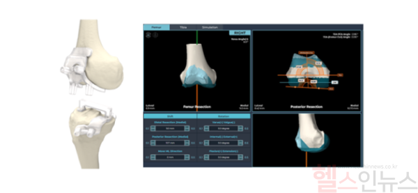 제주대병원이 AI 기반 인공관절 수술 기술 ‘니비게이트’ 임상연구에 참여한다. (제주대병원 제공)