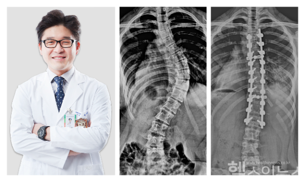 65도 척추측만증 13세 학생이 이정준 국제바로병원 병원장의 수술 성공으로 희망 되찾았다. (사진 제공=국제바로병원)