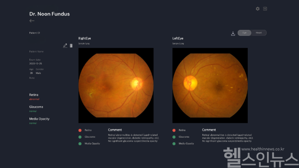 메디웨일 ‘닥터눈 펀더스’, 혁신의료기기 통합심사 승인... 비급여 시장 진출 (사진 제공=메디웨일)