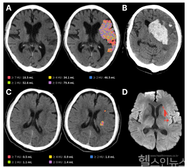 제이엘케이, AI 뇌경색 최신 연구 논문 Frontiers in Neuroscience에 발표 “예후 예측도 AI로” (사진 제공=제이엘케이)
