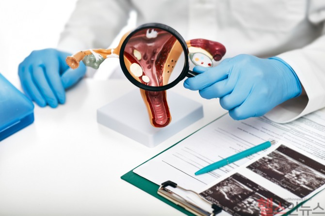 자궁선근증은 과다출혈과 생리통을 유발하며, 가임기 여성에게 흔히 나타나는 질환이다. 자궁이 두꺼워지고 커지는 것이 특징으로, 난임과도 연관될 수 있다 / 사진=클립아트코리아