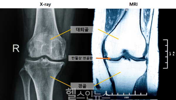 (왼쪽부터) 엑스레이 및 MRI 무릎 사진 (사진 제공=게티이미지뱅크)