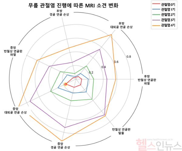 무릎 관절염 진행 단계에 따른 MRI 소견. 관절염 0기(빨간 선)에서도 ‘중앙 대퇴골 연골 손상’이 관찰돼, 이 손상이 무릎 관절염의 중요한 초기 증상으로 나타났다. (사진 제공=서울대병원)