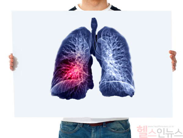 기침과 숨참을 가볍게 넘기지 말고, 폐섬유증을 의심해 조기 진단받는 것이 생존을 좌우한다. (사진 제공=클립아트코리아)