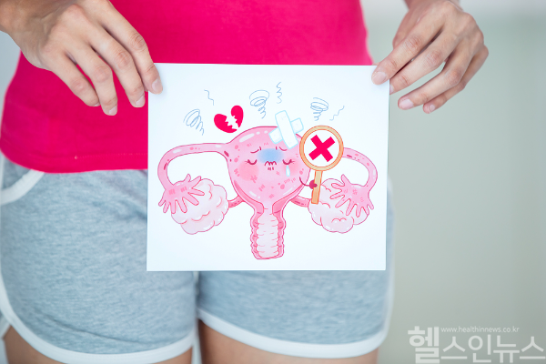 자궁근종은 가임기 여성에게 흔하지만 증상이 없어도 조기 발견과 정기 검진이 중요하다. (클립아트코리아)