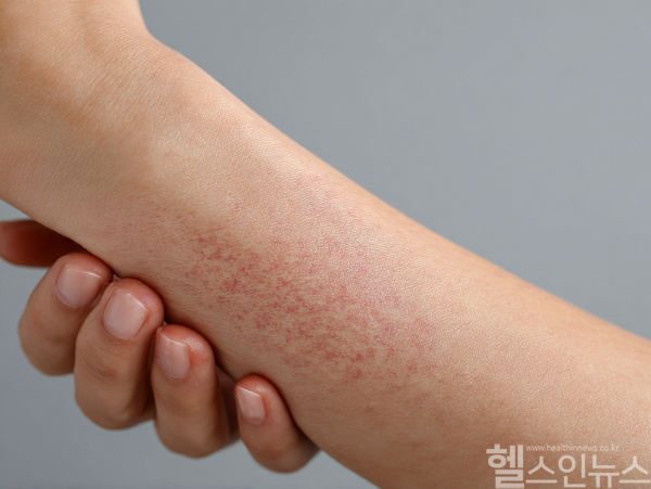 물집 생긴 명절 화상, 초기에 제대로 치료해야 합병증 위험 줄인다. (사진 제공=클립아트코리아)