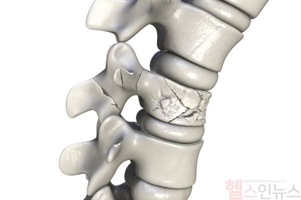 뼈는 조용히 약해진다, 골절이 오기 전 관리가 시작돼야 한다. (사진 제공=클립아트코리아)