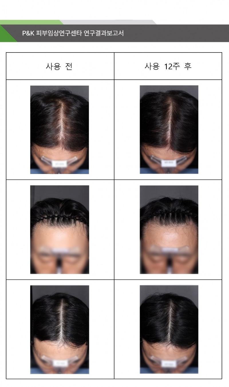 ▲ 국립산림과학원에서 의뢰한 “보리밥나무추출물 시험제품의 탈락 모발 수, 두피 탄력, 두피 보습, 모발 밀도, 모발 굵기, 모발 길이에 대한 인체적용시험”의 임상연구 참여자 전후 사진 (사진=국립산림과학원 P&K 피부임상연구센타 제공)