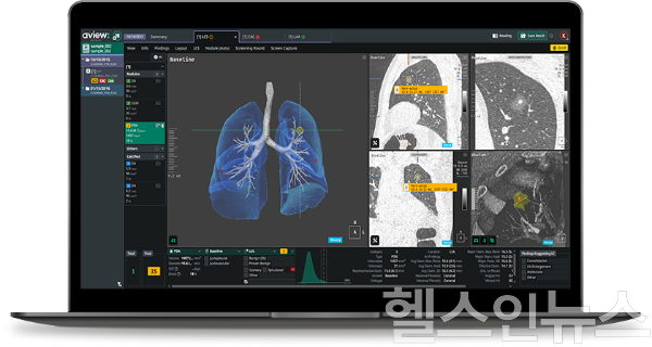 AVIEW LCS (사진 제공=코어라인소프트)