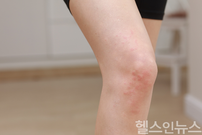 대상포진은 신경을 따라 통증과 물집이 나타나는 질환으로, 겨울철 면역력이 떨어질 때 특히 주의가 필요하다. (이미지 제공=클립아트코리아)